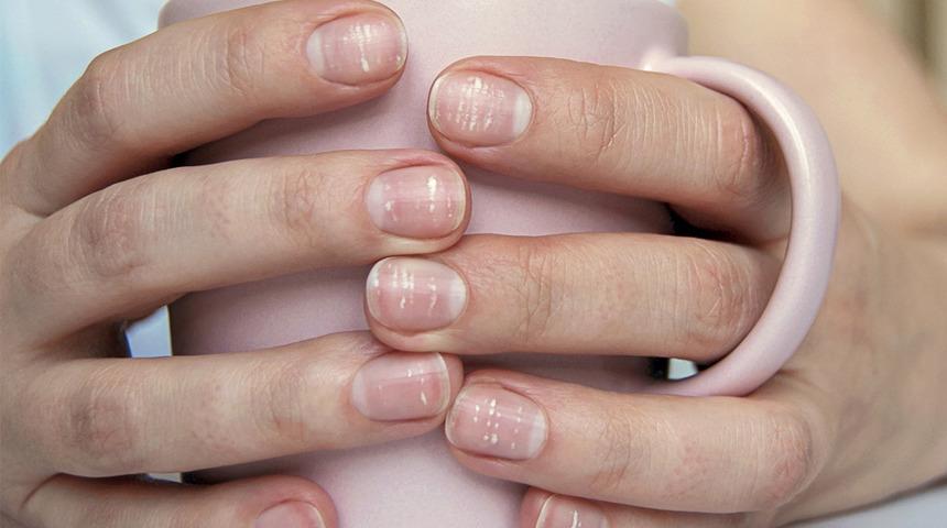 Tırnaklarınız sağlığınız hakkında uyarıyor! Erken teşhis için...