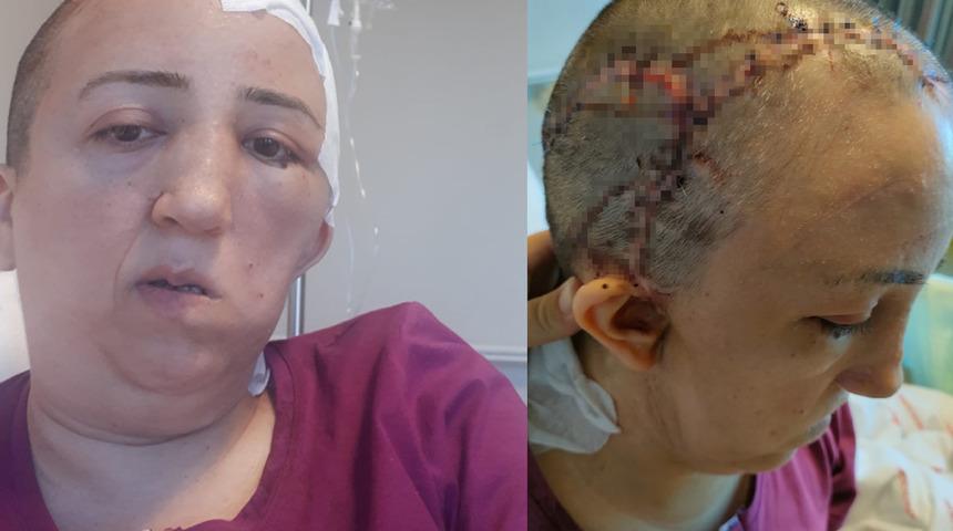 Boynundaki ağrı nedeniyle gitmiş hayatı kararmıştı! Kafatası kaybolan hemşireye kafatası kemiği takıldı