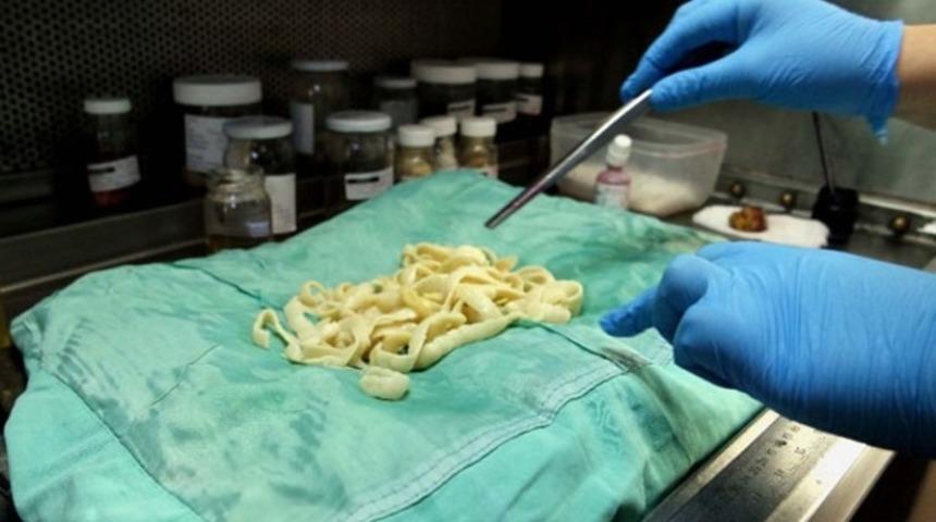 İnce bağırsağından 15 metre tenya çıktı