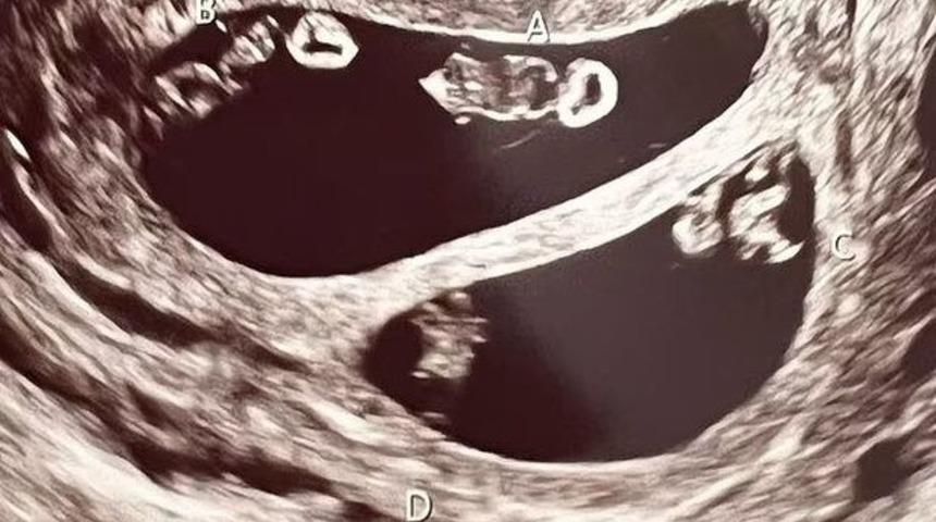 Mucize bekliyorlar! Aynı anda iki çift tek yumurta ikizine hamile