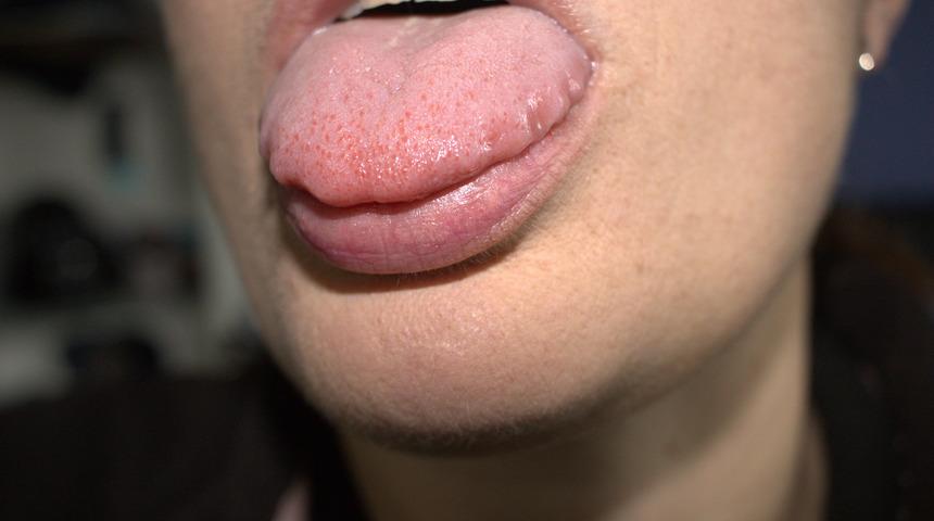 Diliniz büyümeye başladıysa dikkat! Hashimoto hastalığı nedir, neden kaynaklanır?