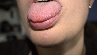 Diliniz büyümeye başladıysa dikkat! Hashimoto hastalığı nedir, neden kaynaklanır?