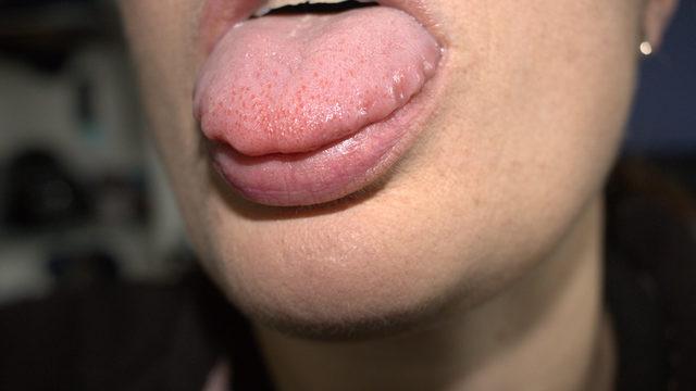 Diliniz büyümeye başladıysa dikkat! Hashimoto hastalığı nedir, neden kaynaklanır?