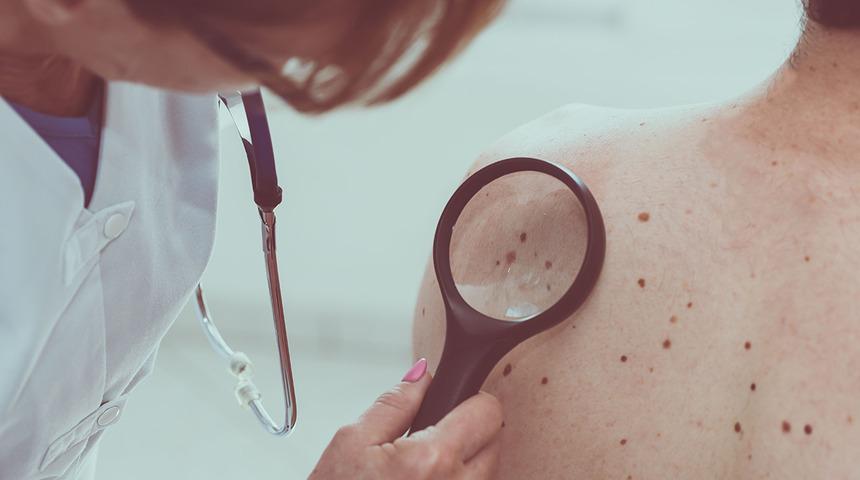 Uzmanlar uyarıyor: Benlerinizin görünümüne dikkat! 