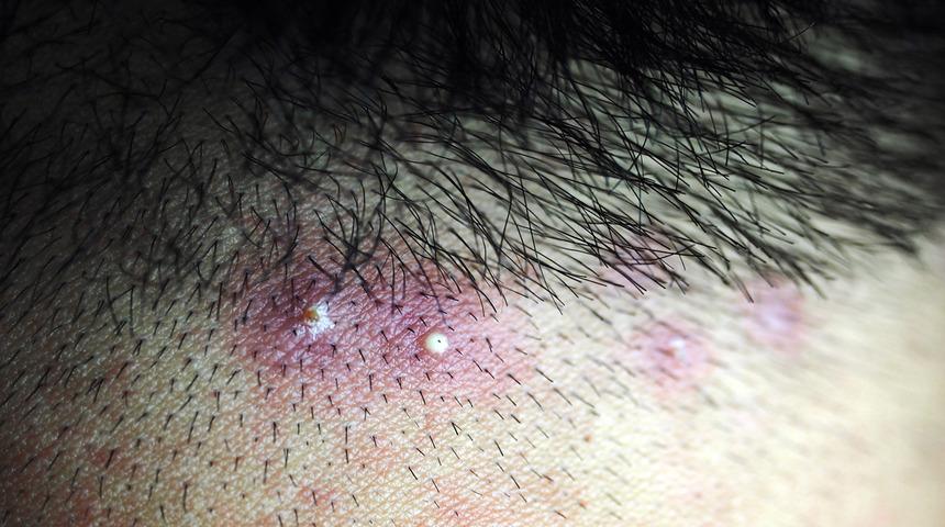 Genellikle zararsız olsa da ölümcül risk taşıyor! Batık kıl tedavisi nasıl olur?