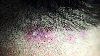 Genellikle zararsız olsa da ölümcül risk taşıyor! Batık kıl tedavisi nasıl olur?