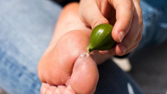 Siğili olan herkes bu hatayı mutlaka yaptı! Uzmanlardan incir egzaması uyarısı