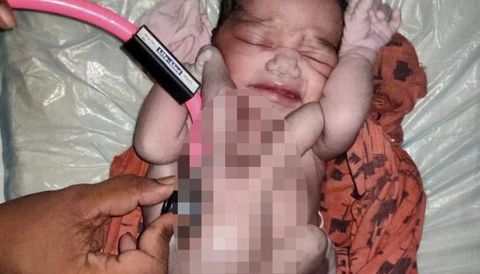 Hindistan’da dört kollu ve dört bacaklı doğan bebek ‘doğanın mucizesi’ olarak karşılandı! Hastaneye akın ettiler