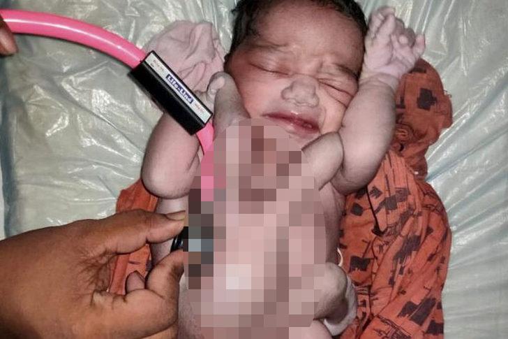 Hindistan’da dört kollu ve dört bacaklı doğan bebek ‘doğanın mucizesi’ olarak karşılandı! Hastaneye akın ettiler