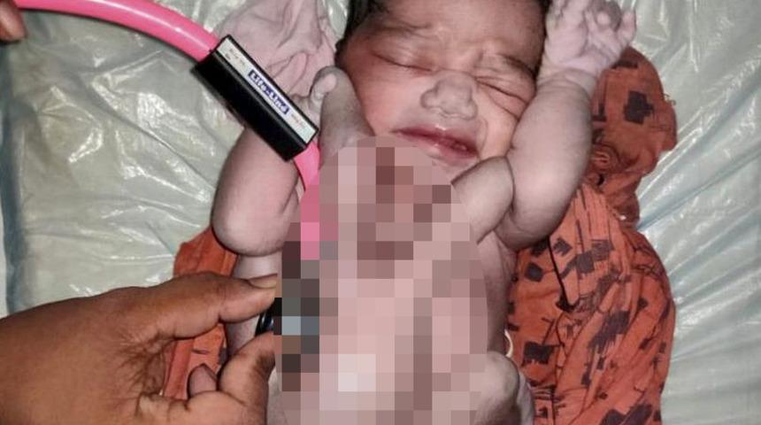 Hindistan’da dört kollu ve dört bacaklı doğan bebek ‘doğanın mucizesi’ olarak karşılandı! Hastaneye akın ettiler