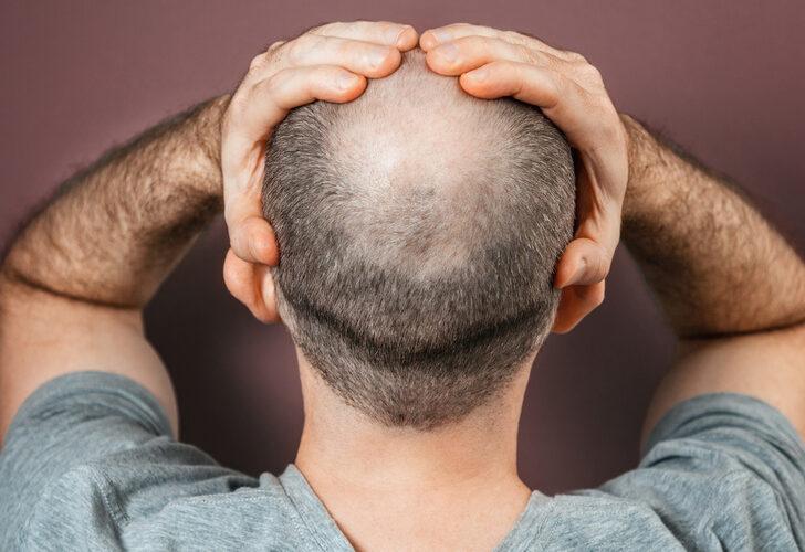 Kellik sorunu tarihe gömülüyor! Olağandışı saç dökülmesi tedavisi