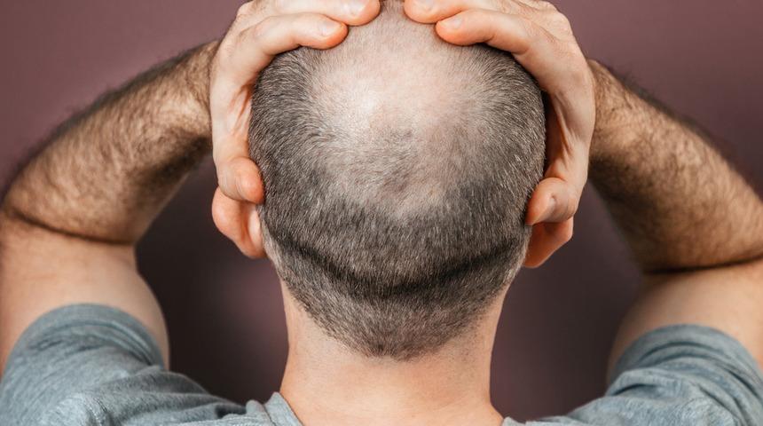 Kellik sorunu tarihe gömülüyor! Olağandışı saç dökülmesi tedavisi