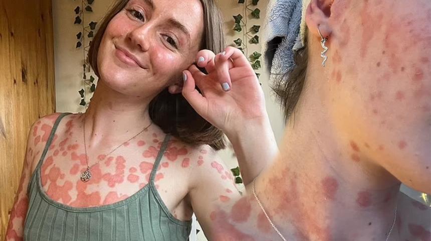 Her şey boğaz ağrısıyla başlamıştı! Vücudu tamamen izlerle kaplandı