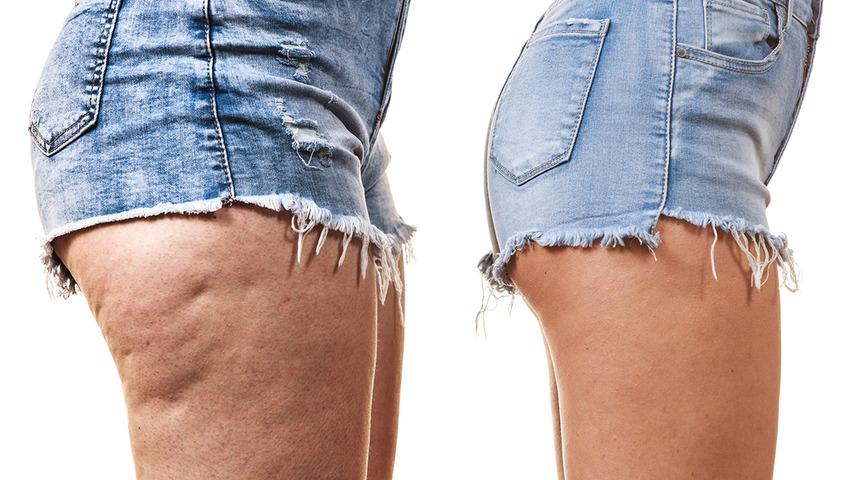 Tatile gitmeden uygulayın! Bu karışım ile selülitlere elveda