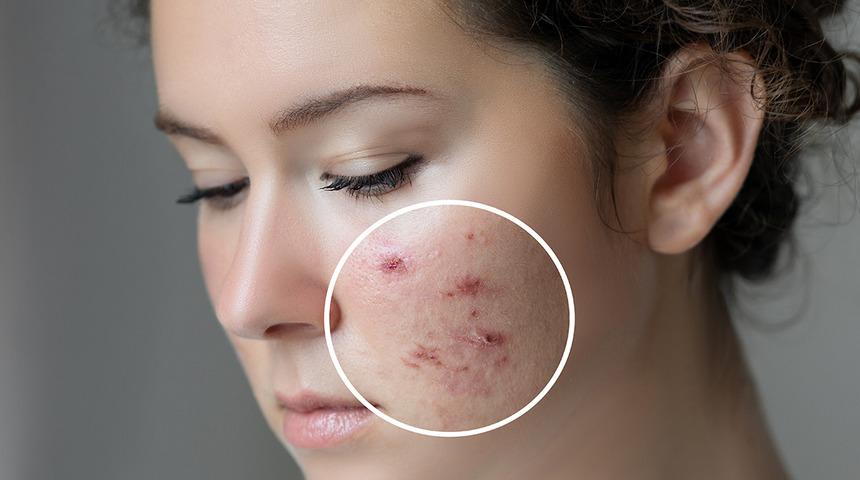 Pürüzsüz cildin sırrı bu maskeden geçiyor! Tamamen evdeki malzemelerle istediğiniz cildi elde edebilirsiniz