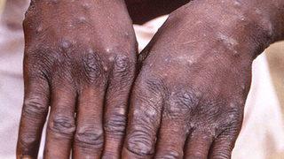 DSÖ'den maymun çiçeği açıklaması! Dünya genelinde kaç vaka var? Sayıyı açıkladılar