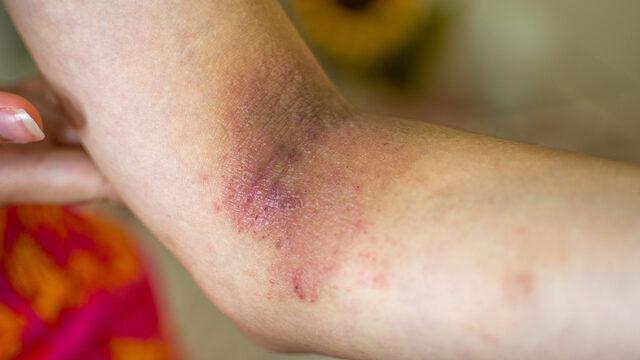 Yara izleri daha kötü olmasın! Yara izi iyileşirken en çok...