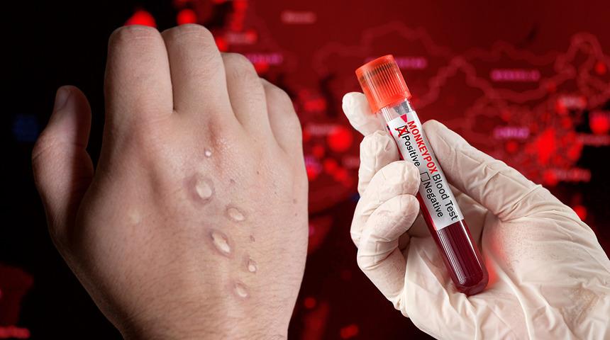 Maymun çiçeğinden kaç kişi öldü? Dünya Sağlık Örgütü'nden açıklama geldi!