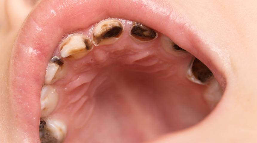 Dişlerinizin tek tek dökülmesine neden olacak! Hassas dişleri daha da kötüleştirecek alışkanlıklar