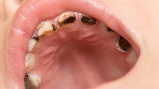 Dişlerinizin tek tek dökülmesine neden olacak! Hassas dişleri daha da kötüleştirecek alışkanlıklar