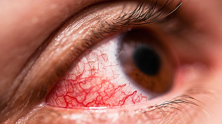 Son evrelere kadar fark edilmiyor: Kör kalabilirsiniz! Göz tansiyonu neden olur?