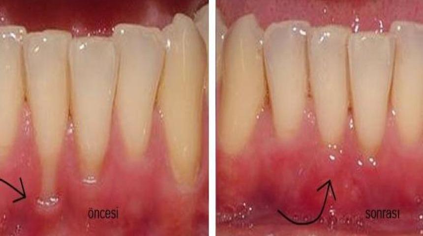 Diş eti &ccedil;ekilmeleri sebepleri ve tedavisi
