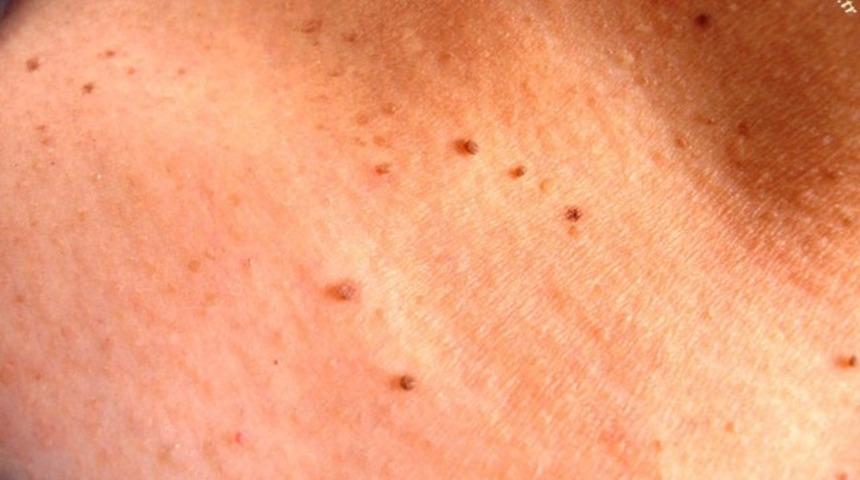 Ben tedavisinde (ben alımında) radyo-frekans teknolojisi