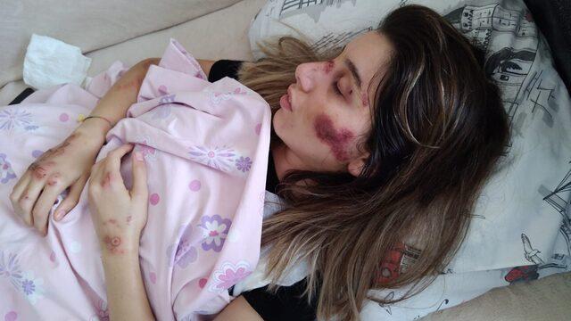 Adana'da aracın çarpması sonucu yaralanan skuter sürücüsü hemşire taburcu edildi