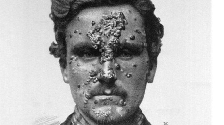 Antibiyotiklerden önce hayat nasıldı?