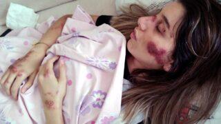 Yoğun bakım hemşiresi scooter kazasında ölümden döndü! Baba isyan etti: Biz bu işkenceyi ne zamana kadar çekeceğiz?