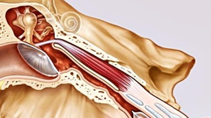 Balon kateter kalpten sonra; kulak hastalıklarının tedavisinde
