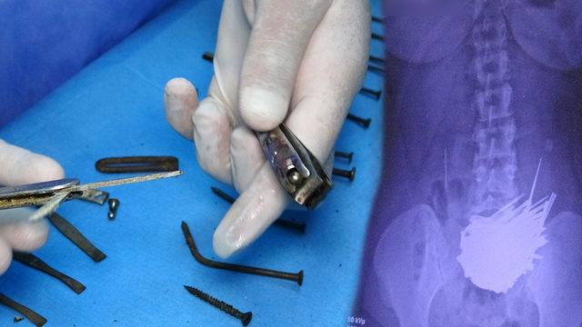 Doktorlar şaşkına döndü! Tırnak makası, çakı, meyve bıçağı... Hepsi midesinden çıktı, tam 158 adet