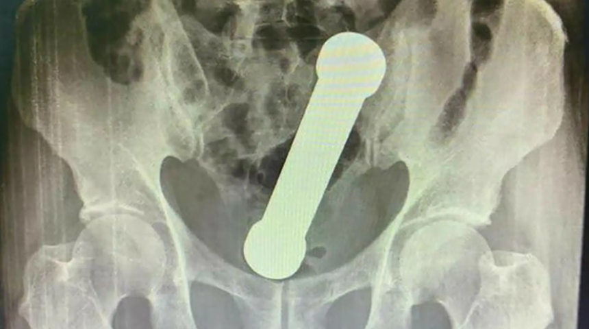 2 gün boyunca öylece durdu! Makatından 20 cm uzunluğunda dambıl çıktı