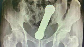 2 gün boyunca öylece durdu! Makatından 20 cm uzunluğunda dambıl çıktı