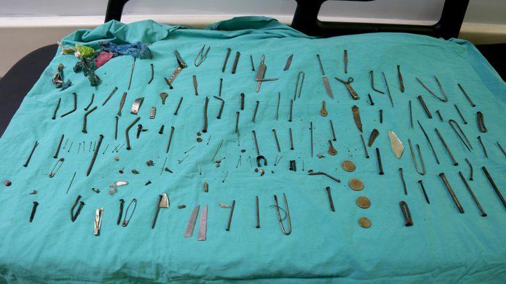 Van'da kadın hastanın midesinden 158 yabancı cisim çıkarıldı G5
