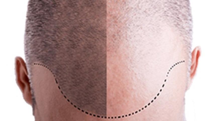 Sa&ccedil; ekimi muayenesinde nelere dikkat ediliyor?