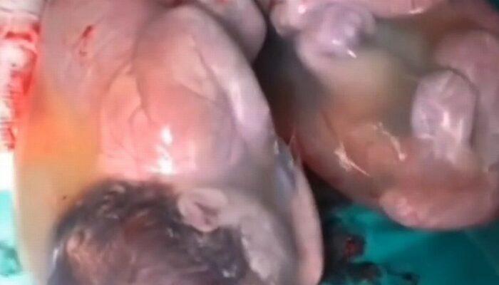 Görenler gözlerine inanamadı! 80 binde bir kez gerçekleşen mucizede ikizler amniyotik keselerle doğdu