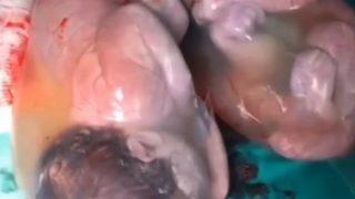 Görenler gözlerine inanamadı! 80 binde bir kez gerçekleşen mucizede ikizler amniyotik keselerle doğdu