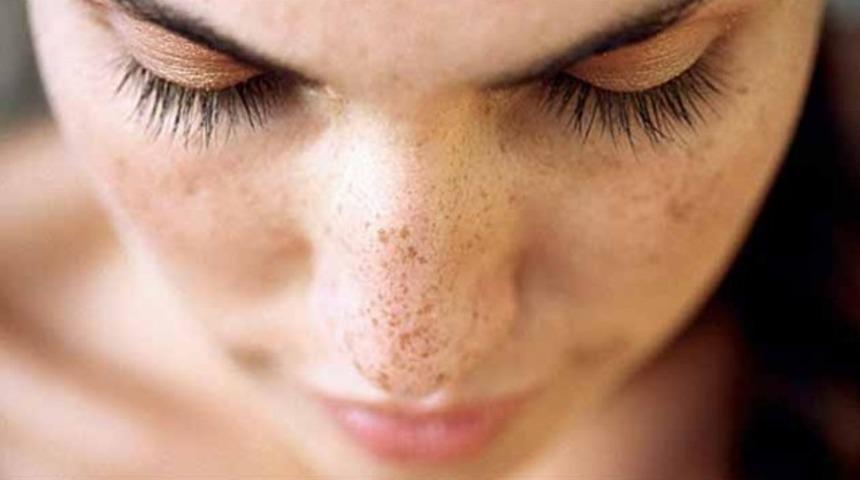 Yaz sonrası cilt lekeleri kabusunuz olmasın