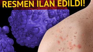 Son dakika: DSÖ'den 'küresel acil durum' ilanı! Maymun çiçeği salgınında panik artıyor