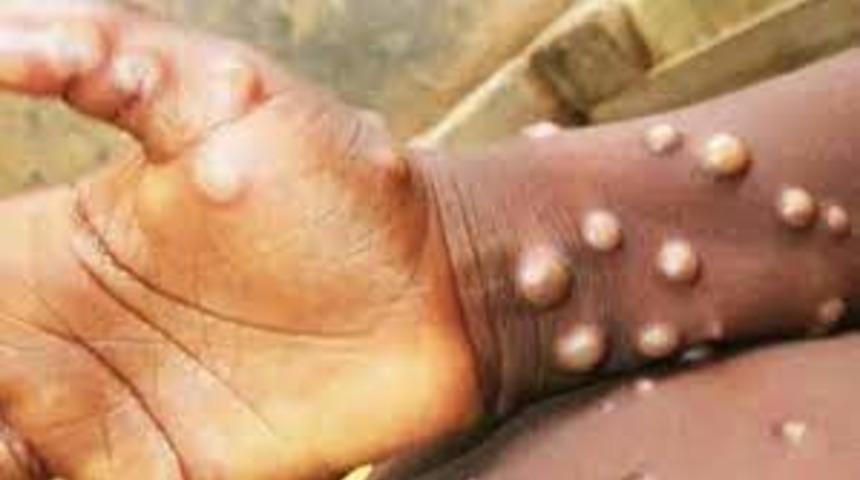 Maymun Çiçeği virüsü belirtileri neler, öldürür mü? DSÖ acil durum ilan etmişti! Maymun Çiçeği virüsü tedavisi var mı?