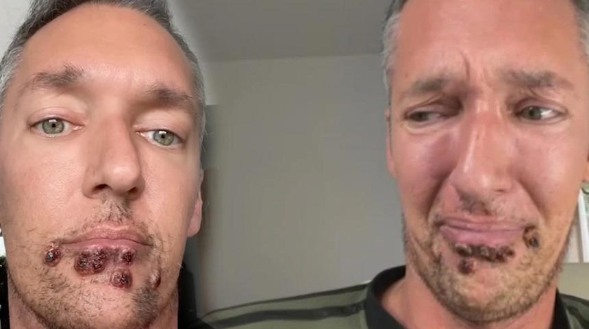 Acil durum ilan edilmişti... Maymun çiçeği hastalığına yakalanan adamın yardım çığlığı yürekleri burktu