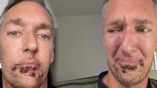 Acil durum ilan edilmişti... Maymun çiçeği hastalığına yakalanan adamın yardım çığlığı yürekleri burktu