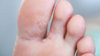 Ayak mantarına ne iyi gelir, evde krem tedavisi ile nasıl geçer? Ayak mantarına iyi gelen bitkisel yöntemler