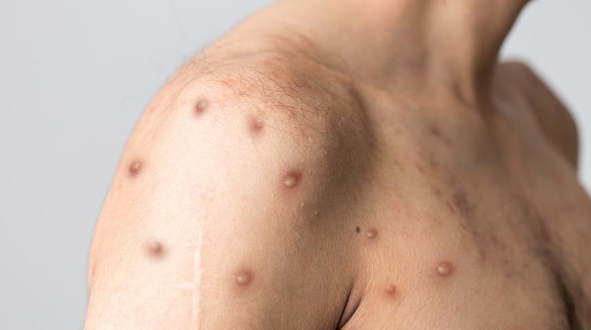 Sağlık Bakanlığı’ndan 'maymun çiçeği virüsü' hamlesi: Tek tek anlattılar