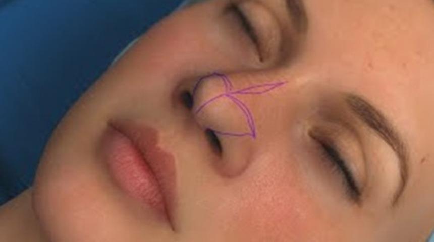 Burun estetiği ile burun şekli nasıl se&ccedil;ilir?