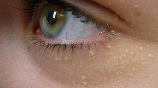 Kalp krizi veya felç geçirmeden anlaşılmıyor! Gözlerinizdeki ölümcül risk: Yüksek kolesterol nedir, yüksek kolesterol neden olur?