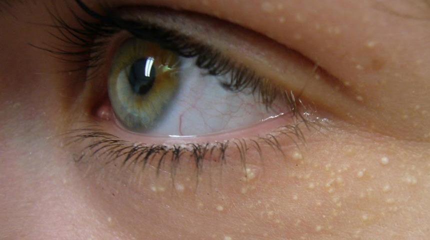 Kalp krizi veya felç geçirmeden anlaşılmıyor! Gözlerinizdeki ölümcül risk: Yüksek kolesterol nedir, yüksek kolesterol neden olur?