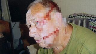 Evinin önündeki kuş yuvasına hamle yaptı! Martının saldırısına uğrayan adam kanlar içinde kaldı