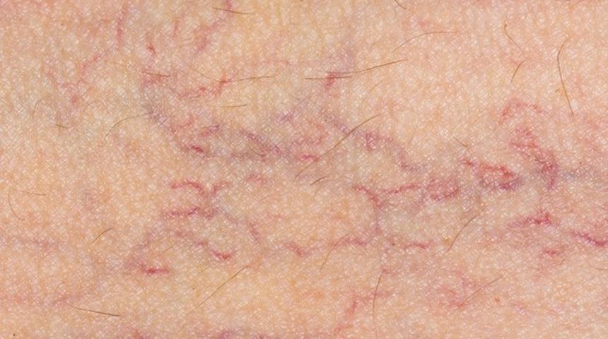 Kılcal damar tedavisinde radyo frekans teknolojisi